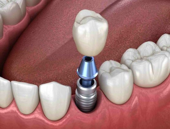 Cosmetic-dentistry-portland-implants-bone-grafts.jpg